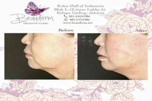 Tarik Benang (Threadlift)